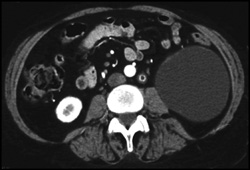 Inflammation of the Left Ureter - CTisus CT Scan