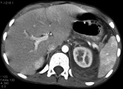 Renal Laceration With Perirenal Hematoma and Contrast Extravasation - CTisus CT Scan