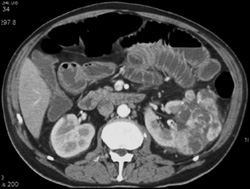 Renal Cell Carcinoma - CTisus CT Scan