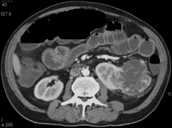 Renal Cell Carcinoma - CTisus CT Scan