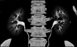 Transitional Cell Carcinoma of the Left Kidney - CTisus CT Scan