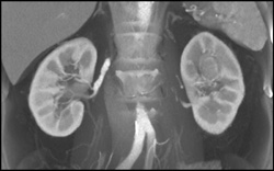 Transitional Cell Carcinoma of the Left Kidney - CTisus CT Scan