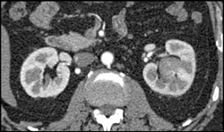 Transitional Cell Carcinoma of the Left Kidney - CTisus CT Scan