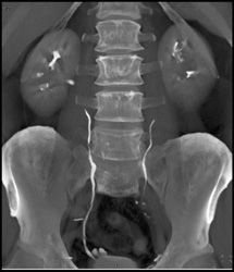 Transitional Cell Carcinoma of the Left Kidney - CTisus CT Scan