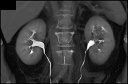 Transitional Cell Carcinoma of the Left Kidney - CTisus CT Scan