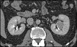 Transitional Cell Carcinoma of the Left Kidney - CTisus CT Scan