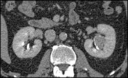 Transitional Cell Carcinoma of the Left Kidney - CTisus CT Scan