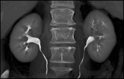 Transitional Cell Carcinoma of the Left Kidney - CTisus CT Scan