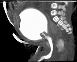 Bladder Cancer With CT Cystogram - CTisus CT Scan