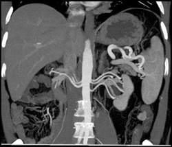 Multiple Renal Arteries - CTisus CT Scan