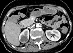 Renal Cyst With Mural Nodule - CTisus CT Scan