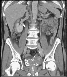 Bladder Cancer - CTisus CT Scan