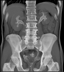 Bladder Cancer - CTisus CT Scan