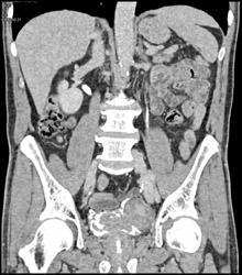 Bladder Cancer - CTisus CT Scan