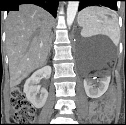 Renal Laceration With Urinoma - CTisus CT Scan