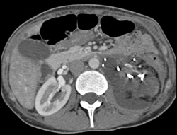 Urinoma S/P Resection S/P Trauma - CTisus CT Scan