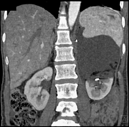 Resolving Hematoma and Laceration of Left Kidney - CTisus CT Scan