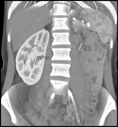 Solitary Right Kidney in Potential Renal Donor - CTisus CT Scan