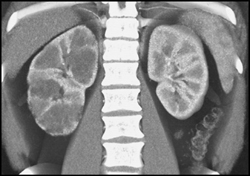 Right Hydronephrosis and Pyelonephritis - CTisus CT Scan