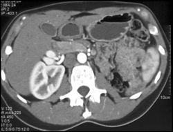 Solitary Right Kidney in A Renal Donor - CTisus CT Scan