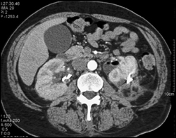 Perirenal Hematoma S/P Nephrostomy - CTisus CT Scan