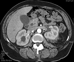 Nephrostomy Tube Placement - CTisus CT Scan