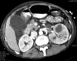 Acute Pyelonephritis-l Is Greater Than R - CTisus CT Scan