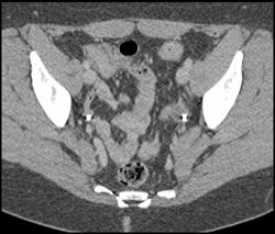 Endometrioma on Left Distal Ureter - CTisus CT Scan