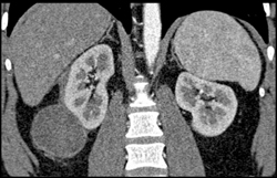 Resolving Right Renal Hematoma - CTisus CT Scan