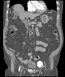 Penile Prosthesis Reservoir in Left Pelvis - CTisus CT Scan