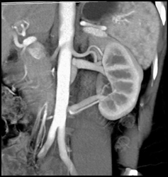 2 Left Renal Veins and Circumaortic Renal Vein - CTisus CT Scan