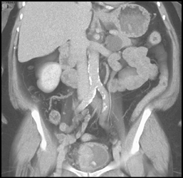 Bladder Cancer - CTisus CT Scan