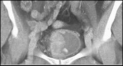 Bladder Cancer - CTisus CT Scan