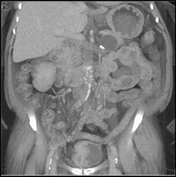 Bladder Cancer - CTisus CT Scan