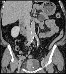 Bladder Cancer - CTisus CT Scan