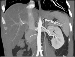 Prehilar Branching - CTisus CT Scan