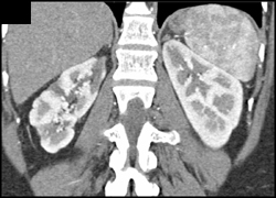 Scarring of Right Kidney Due to Chronic Pyelonephritis - Kidney Case ...