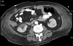 Acute Pyelonephritis - CTisus CT Scan