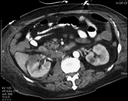 Acute Pyelonephritis - CTisus CT Scan