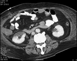 Acute Pyelonephritis - CTisus CT Scan