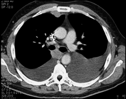 Renal Cell Carcinoma Metastatic to the Hilum and Internal Mammary Nodes - CTisus CT Scan