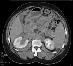 Renal Lymphoma - CTisus CT Scan