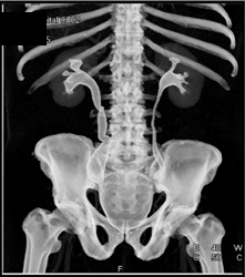 Right Hydronephrosis With Ureteropelvic Junction (UPJ) Obstruction - CTisus CT Scan