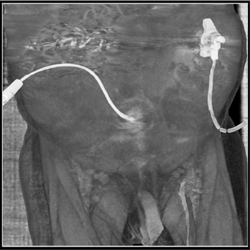 Catheter Outside Bladder With Contrast Extravasation - CTisus CT Scan