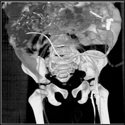 Free Intraperitoneal Contrast - CTisus CT Scan