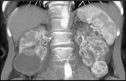 Bilateral Renal Cell Carcinomas in Polycystic Kidney Disease - CTisus CT Scan