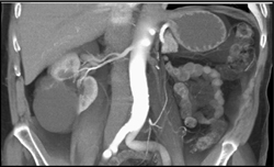 Cystic Renal Cell Carcinoma - CTisus CT Scan