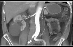 Cystic Renal Cell Carcinoma - CTisus CT Scan