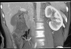 Normal Cortico-medullary Phase With Small Calculi Left Kidney in Lower Pole - CTisus CT Scan