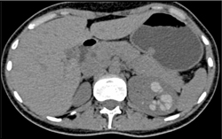 Unusual High Density Dilated Left Calyceal System - CTisus CT Scan